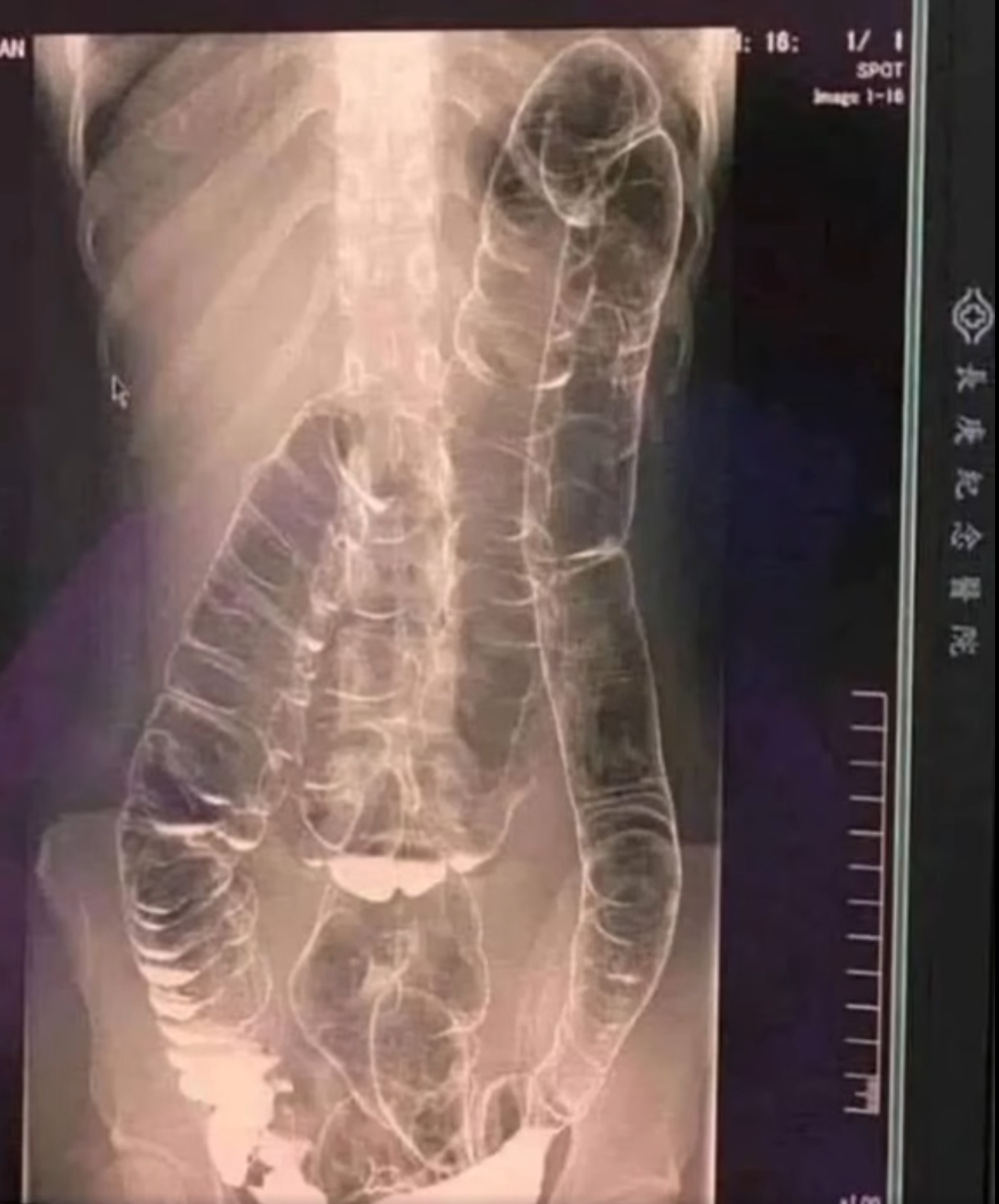 This is an X-ray image of a young woman who suffered from chronic constipation.